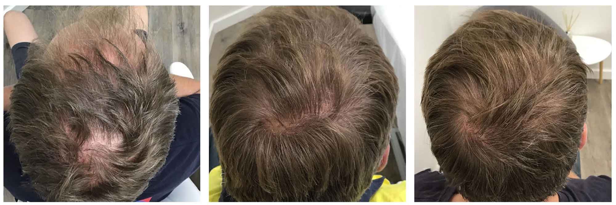 درمان سریع و قطعی تاسی سر با کوکتل فیوژن F-HAIR MEN