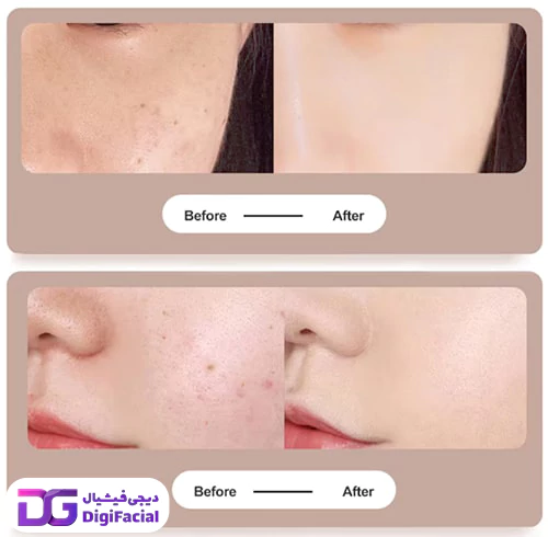 دستگاه پلاسما بیوتی پن 15 قدرته Mole